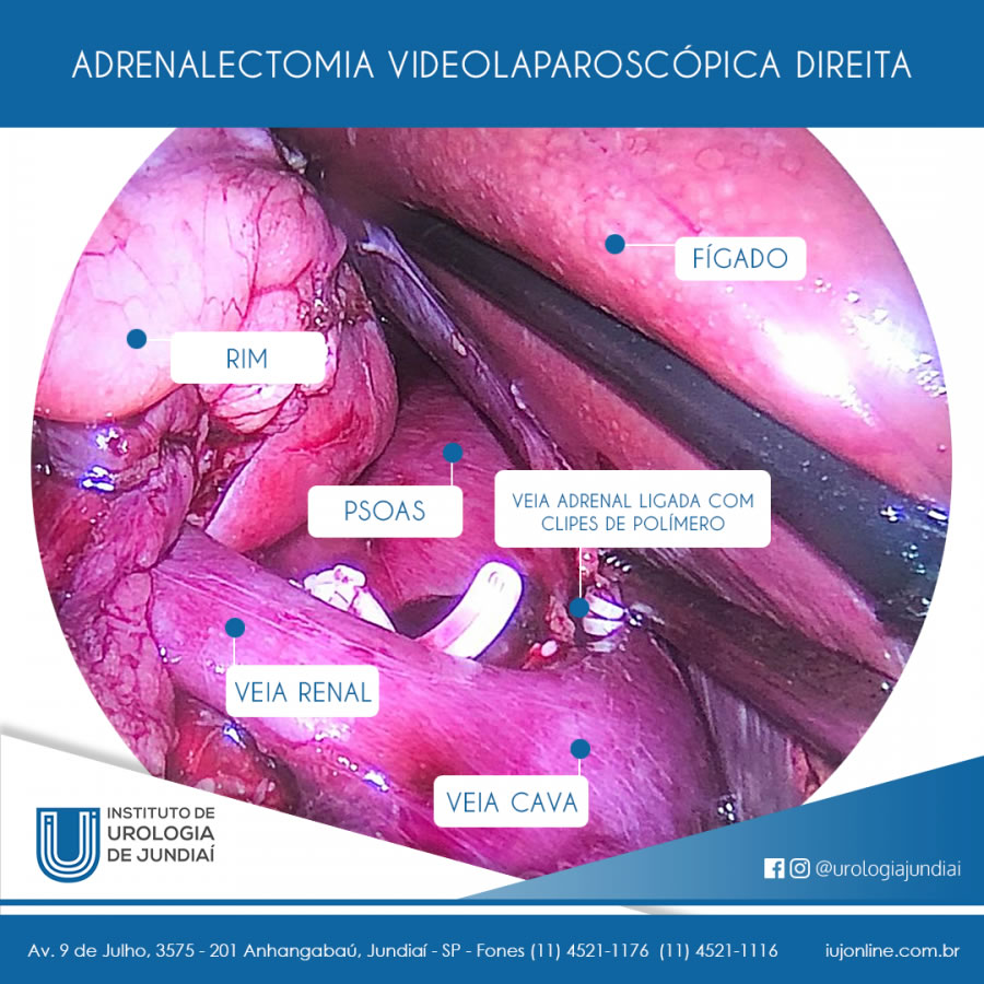 Videolaparoscopia para uso da Urologia