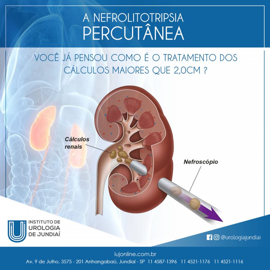 Você já pensou como é o tratamento dos cálculos maiores do que 2,0 cm?