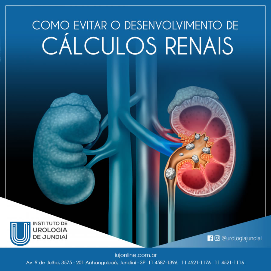 Como evitar o desenvolvimento de cálculos renais