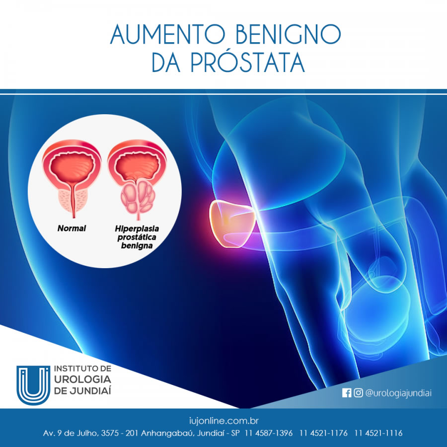 Aumento Benigno da Próstata