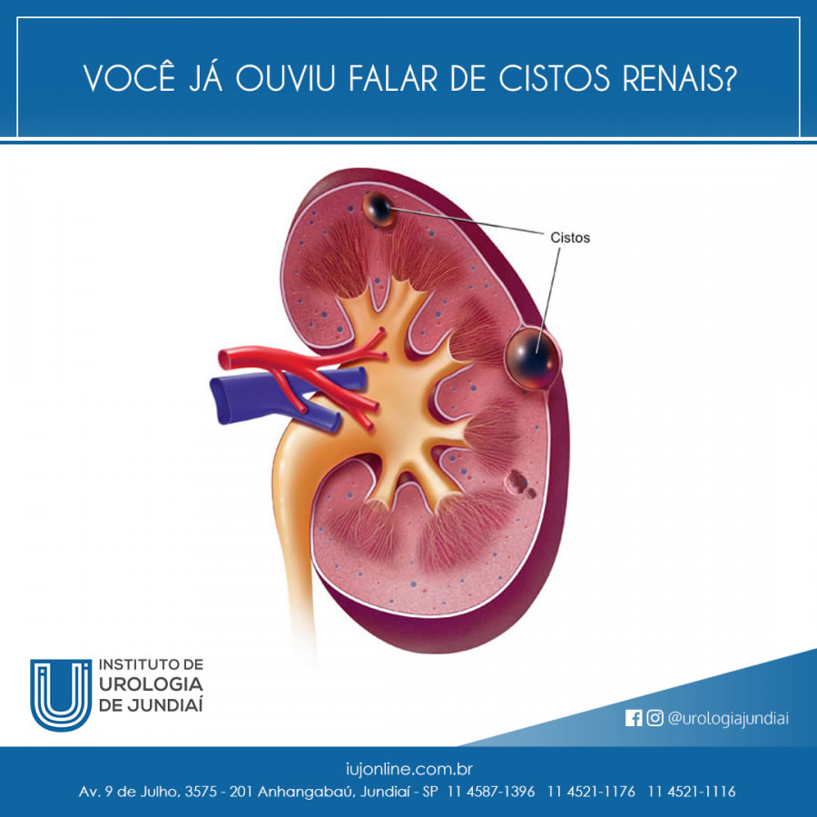 Você já ouviu falar de cistos renais?