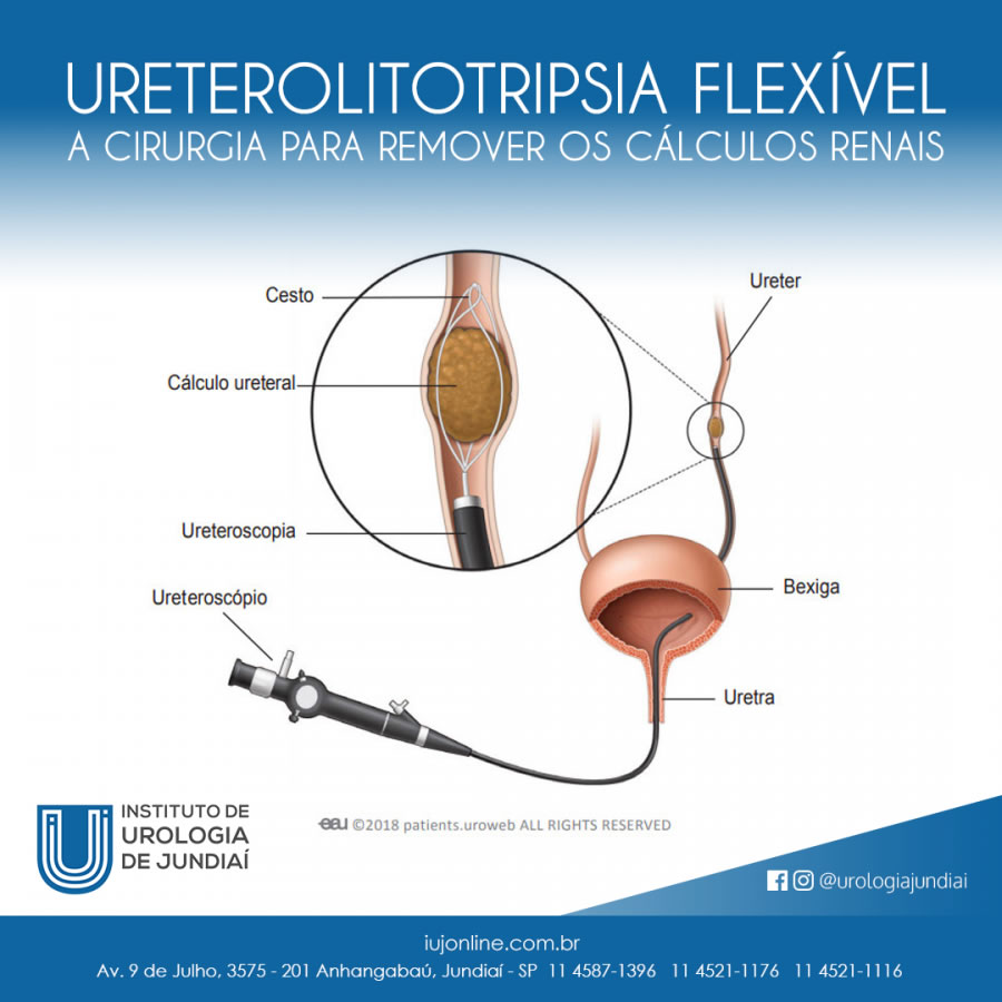 A cirurgia para remover os Cálculos Renais