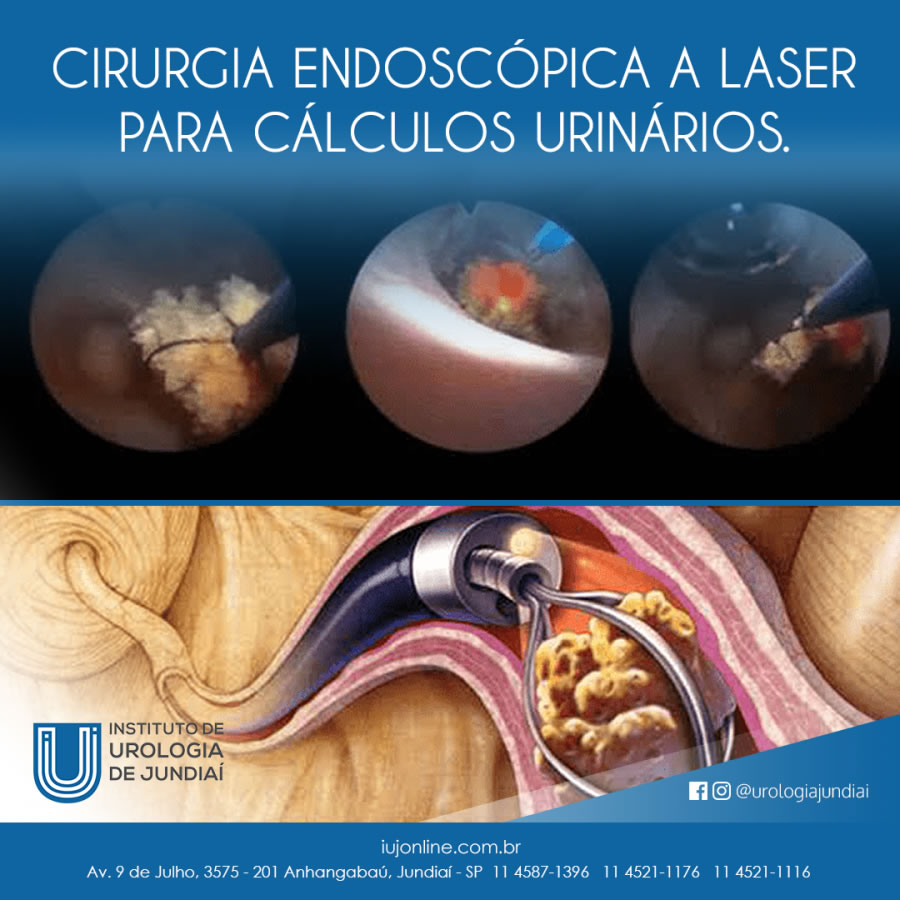 Curiosidades sobre a Cirurgia Endoscópica a Laser para Cálculos Urinários