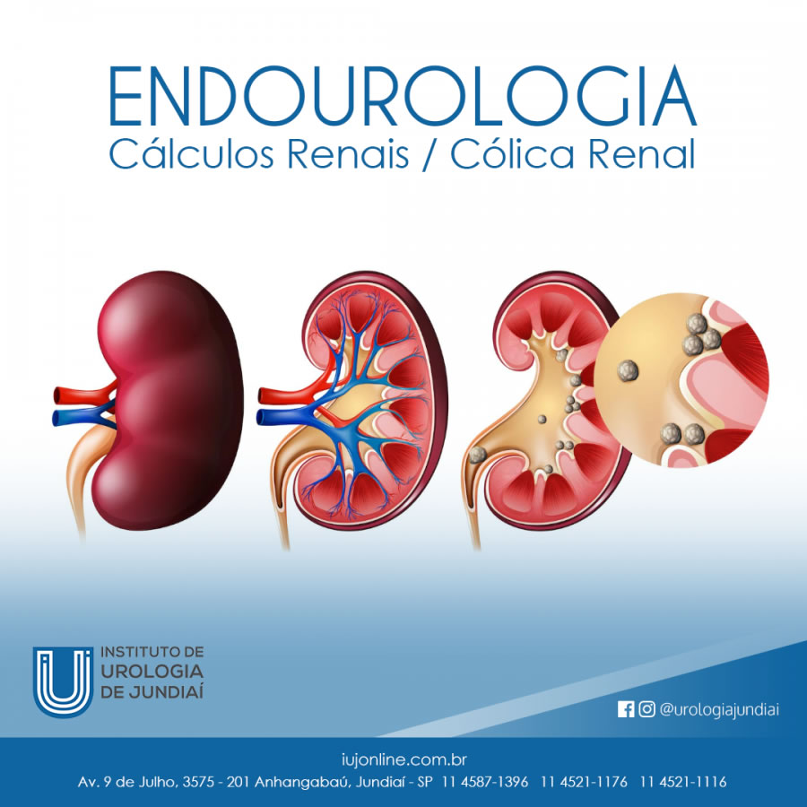 Endourologia Cálculos Renais / Cólica Renal