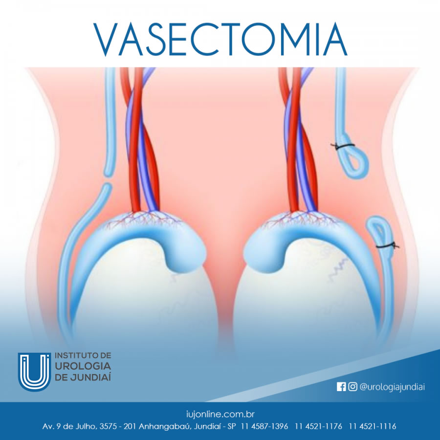 Vasectomia