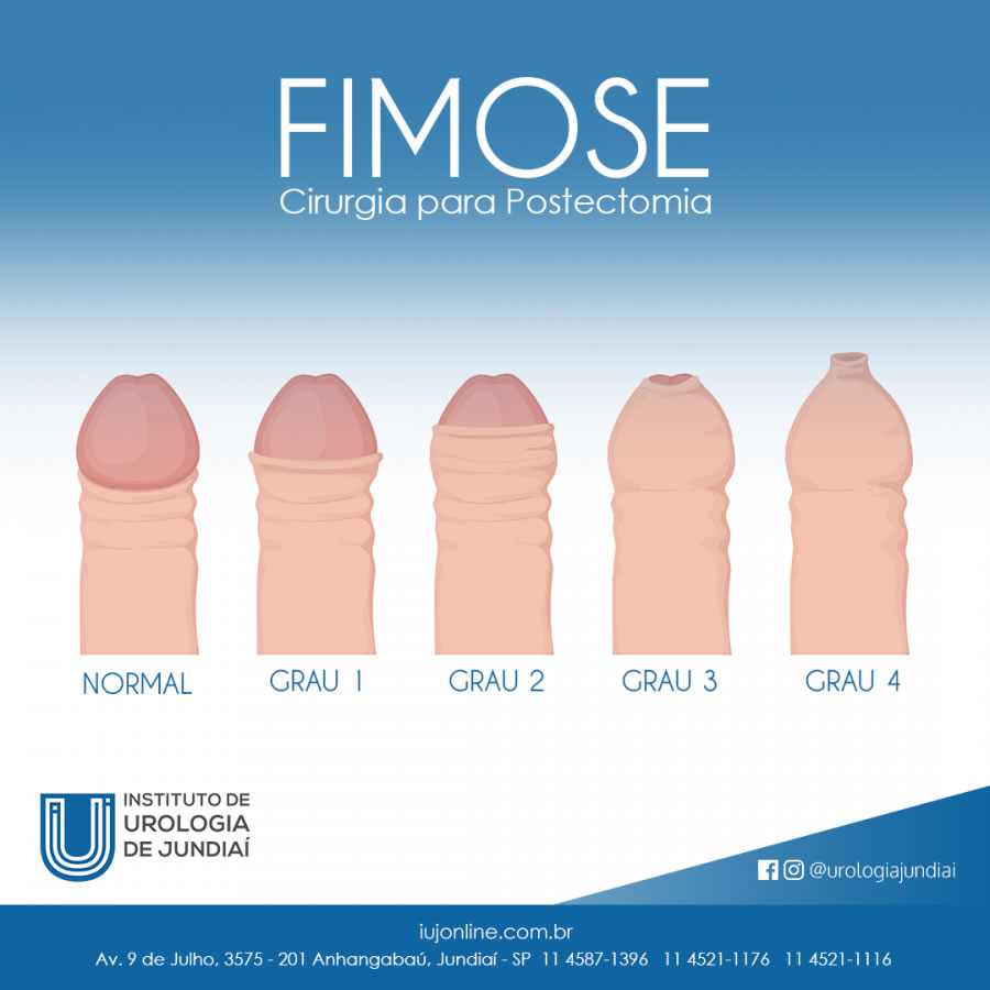 Postectomia (Cirurgia para Fimose)