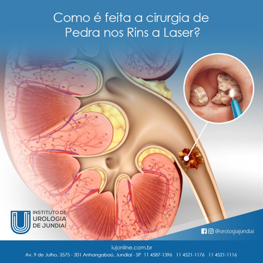 Como é feita a cirurgia de Pedra nos Rins a Laser?